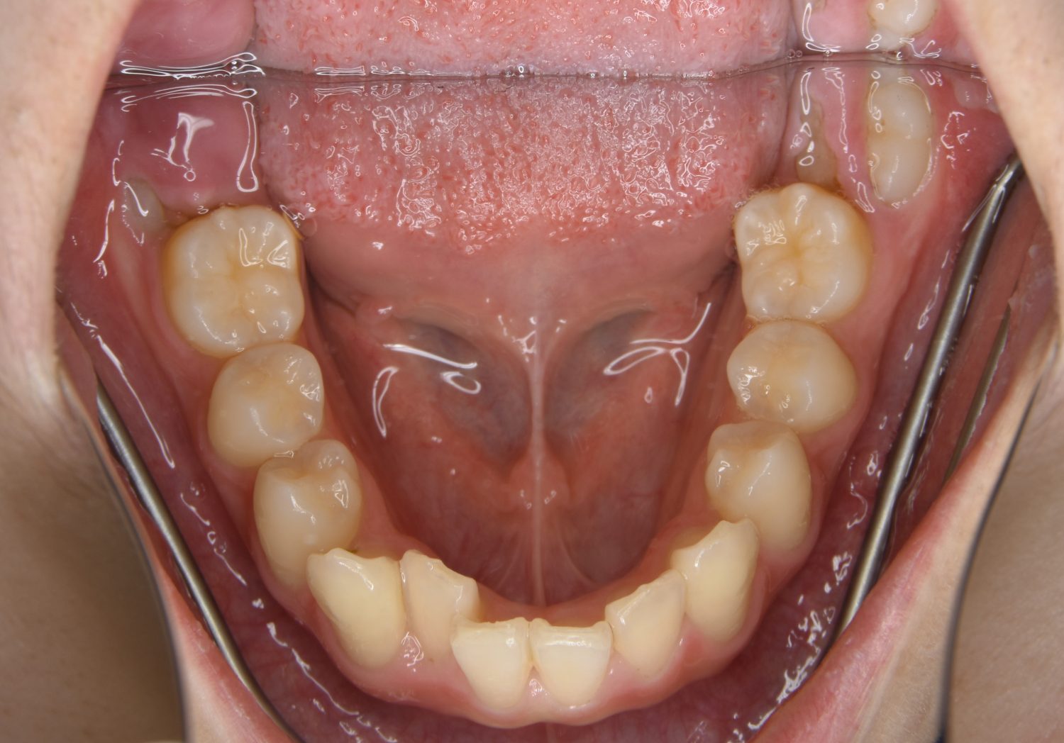 ピーススマイル矯正歯科 叢生② before 下側