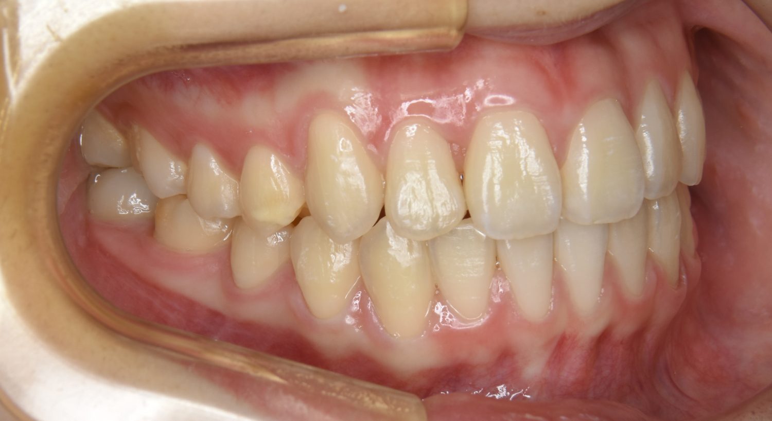 ピーススマイル矯正歯科 叢生② after 右側