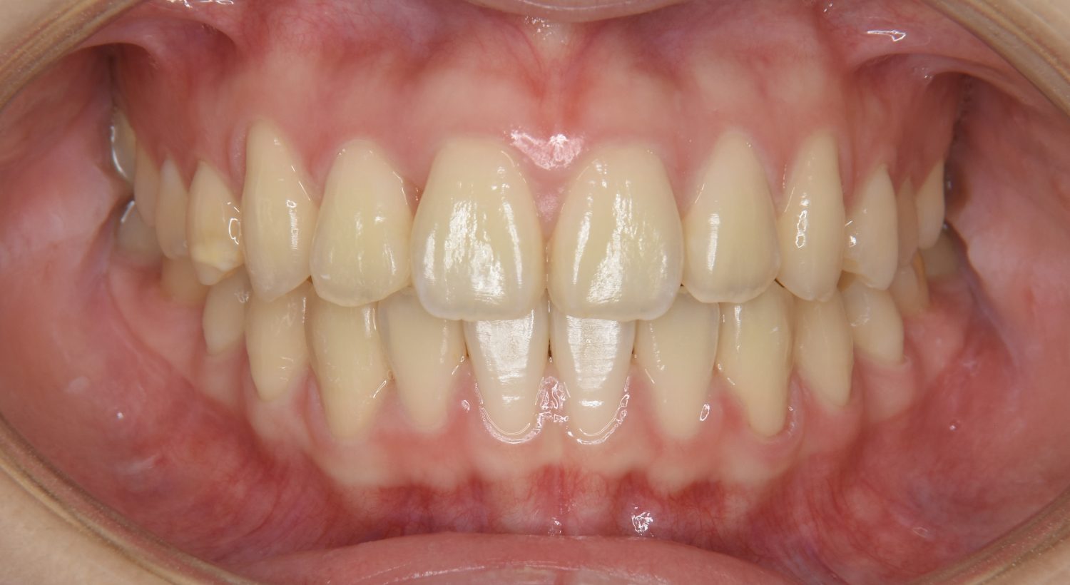 ピーススマイル矯正歯科 叢生② after 正面