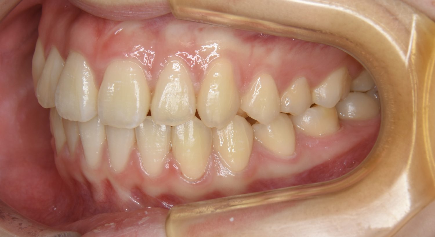 ピーススマイル矯正歯科 叢生② after 左側