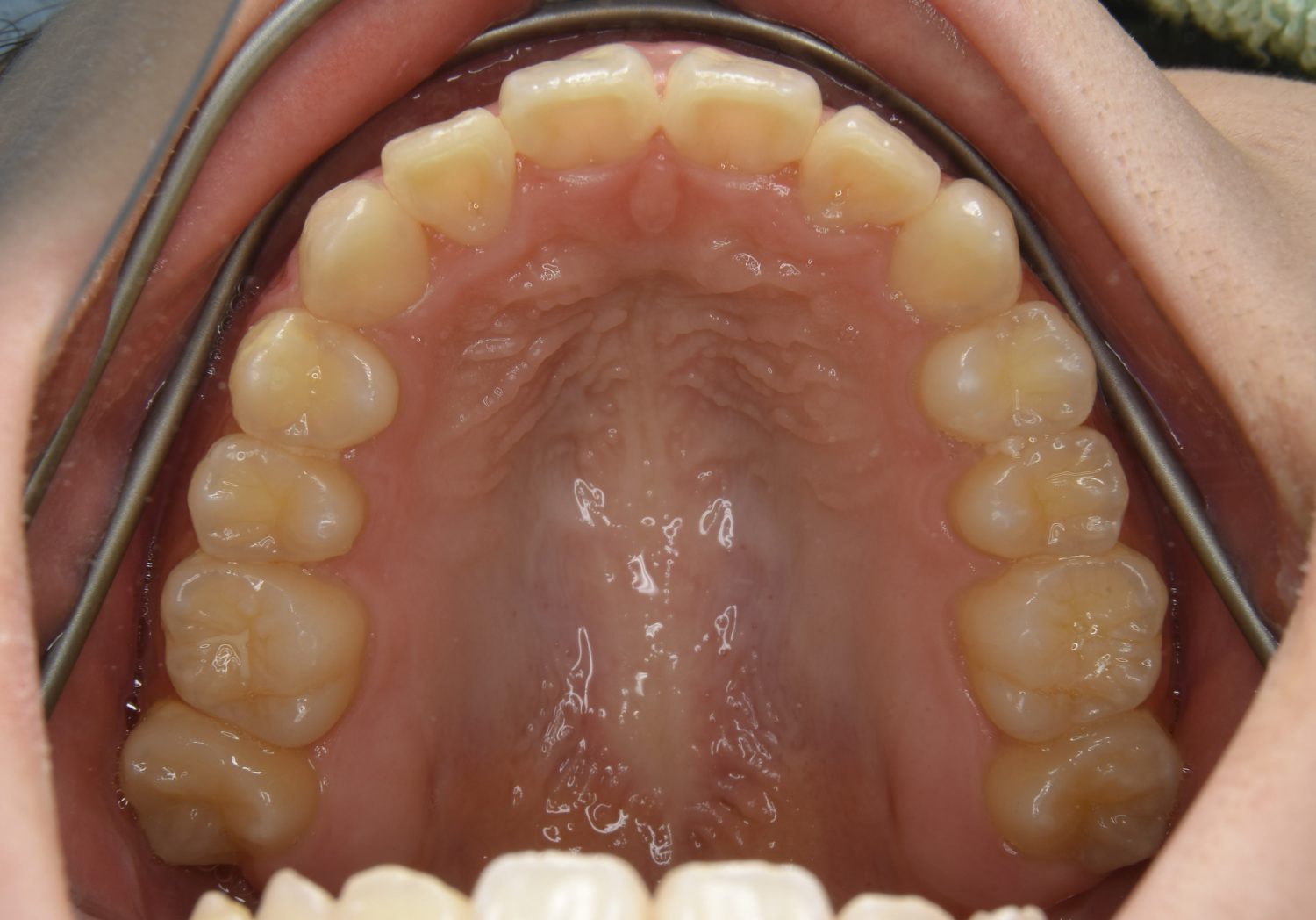 ピーススマイル矯正歯科 叢生② after 上側