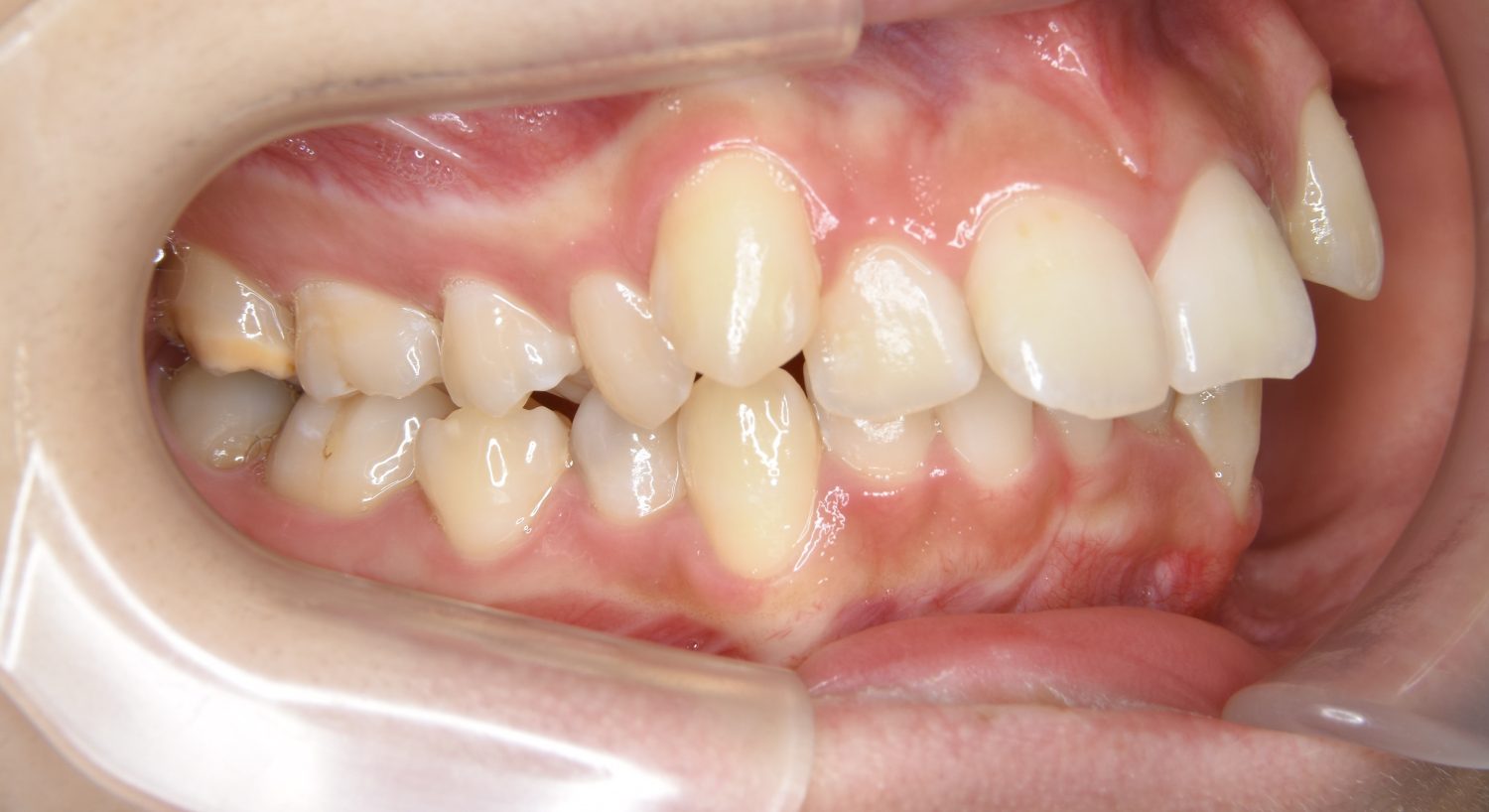 ピーススマイル矯正歯科 上顎前突① before 右側