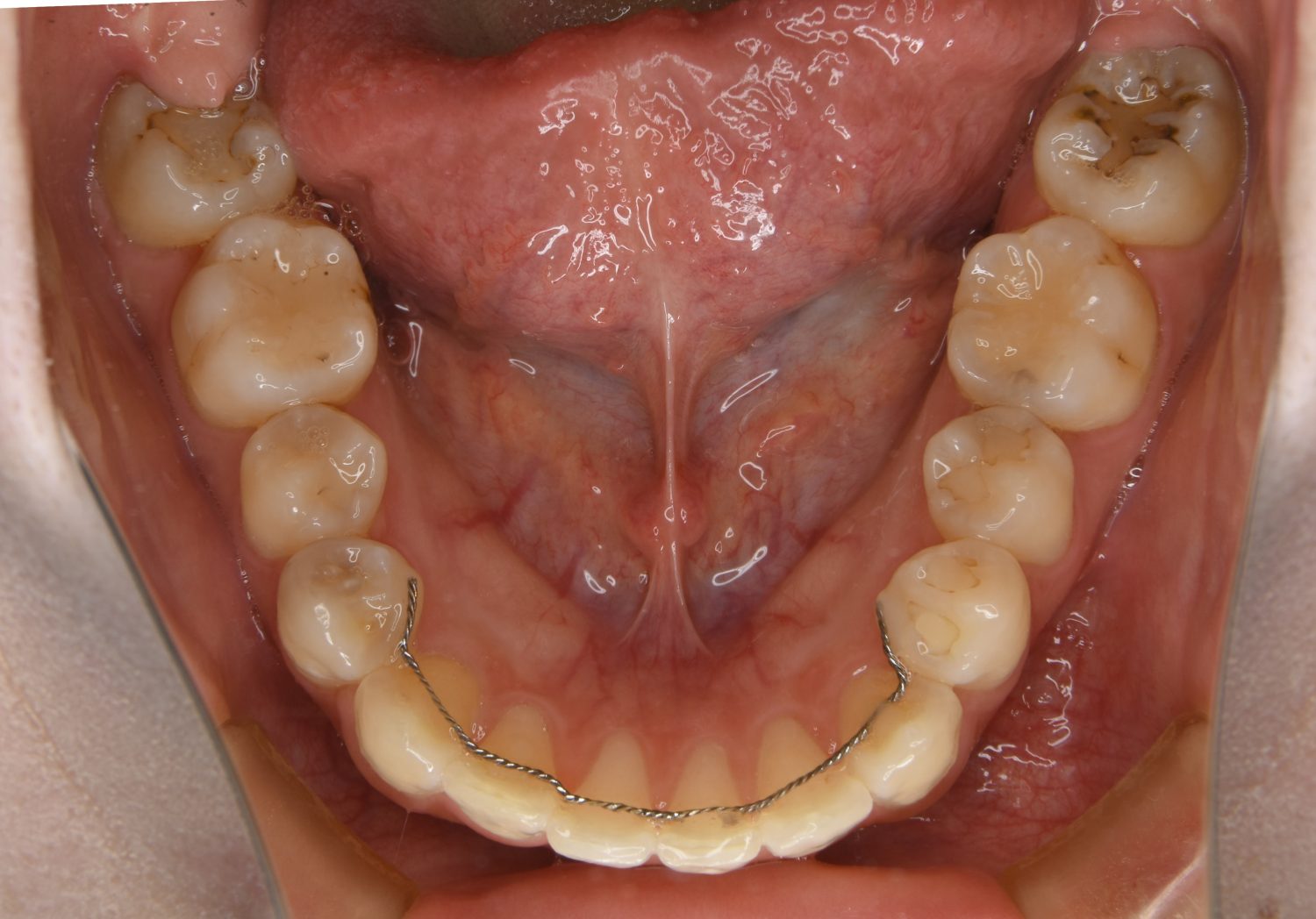 ピーススマイル矯正歯科 上顎前突① after 下側