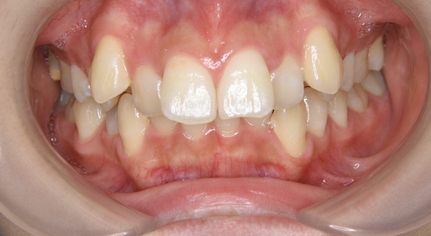 ピーススマイル矯正歯科 上顎前突① before