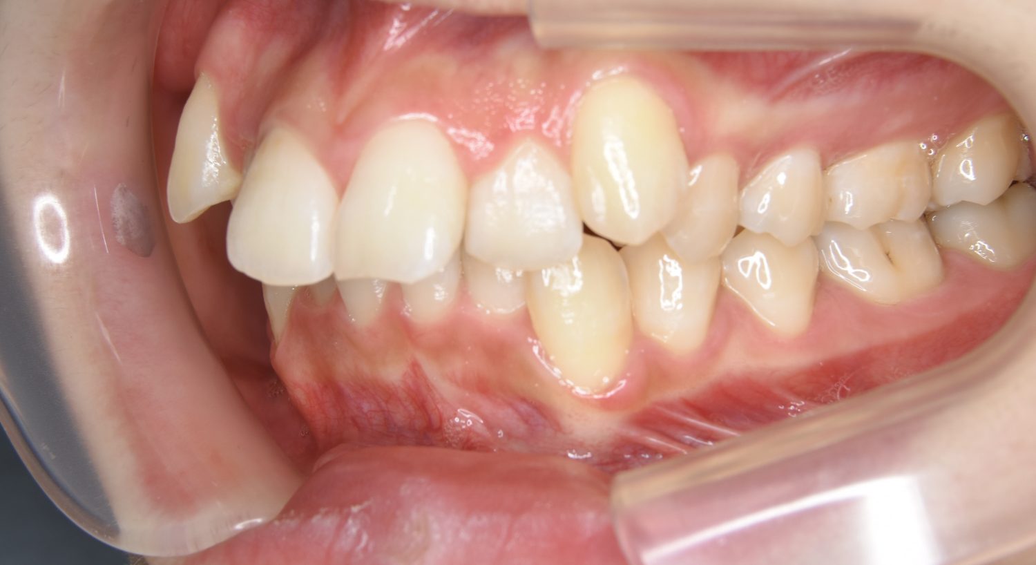 ピーススマイル矯正歯科 上顎前突① before 左側