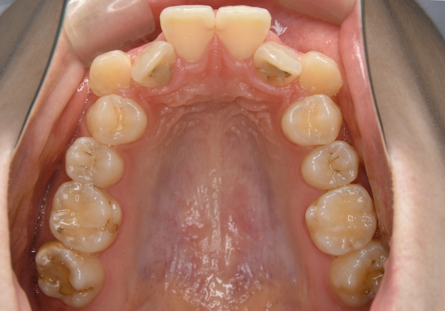 ピーススマイル矯正歯科 上顎前突① before 上側