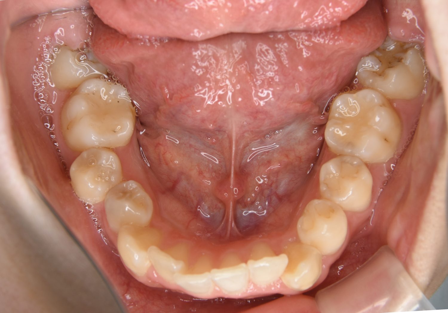 ピーススマイル矯正歯科 上顎前突① before 下側