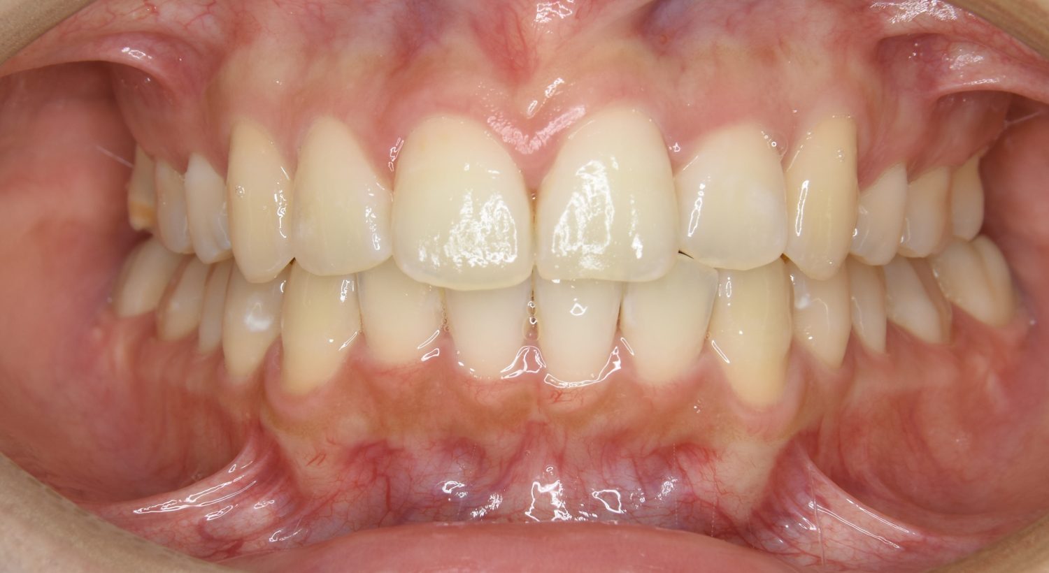 ピーススマイル矯正歯科 上顎前突① after 正面