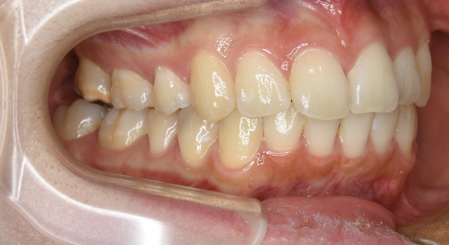 ピーススマイル矯正歯科 上顎前突① after 右側