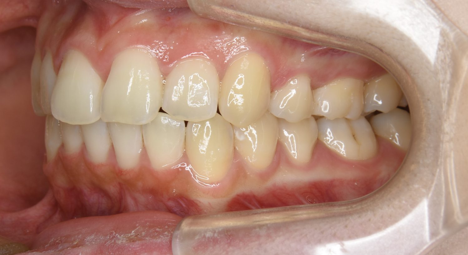 ピーススマイル矯正歯科 上顎前突① after 左側