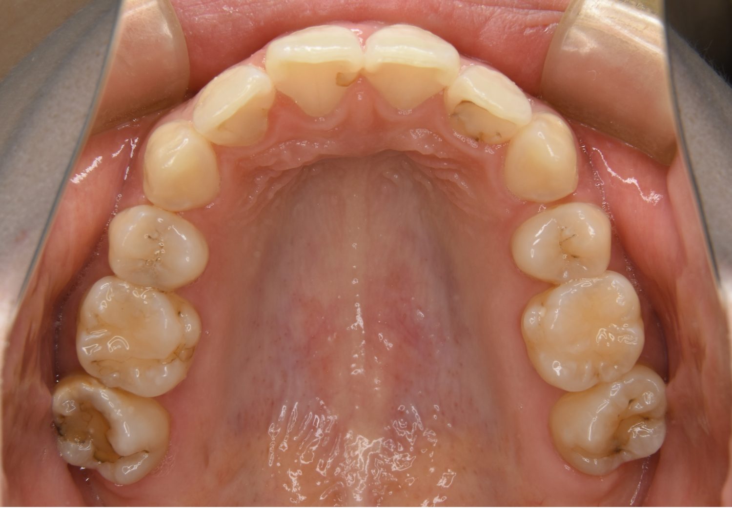 ピーススマイル矯正歯科 上顎前突① after 上側