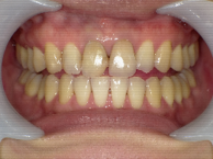 はりま歯科クリニック-ホワイトニング②-before-正面