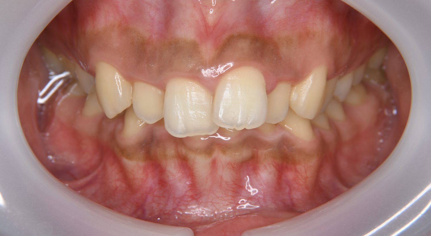 ピーススマイル矯正歯科 上顎前突② before