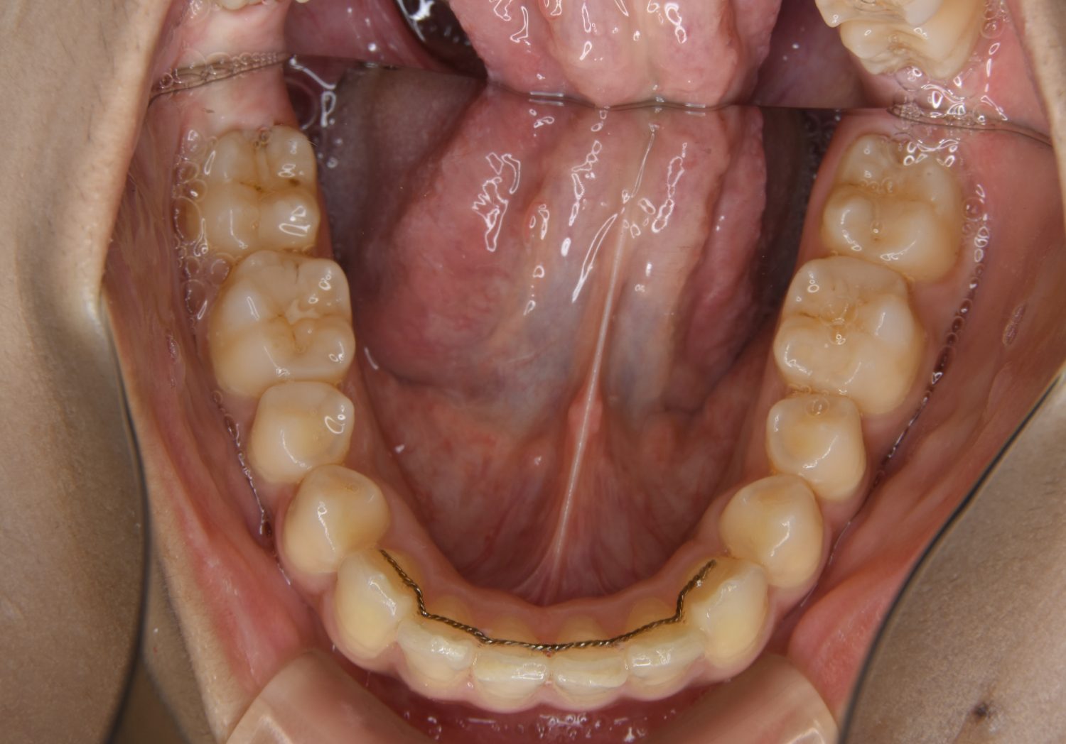 ピーススマイル矯正歯科 上顎前突② after 下側