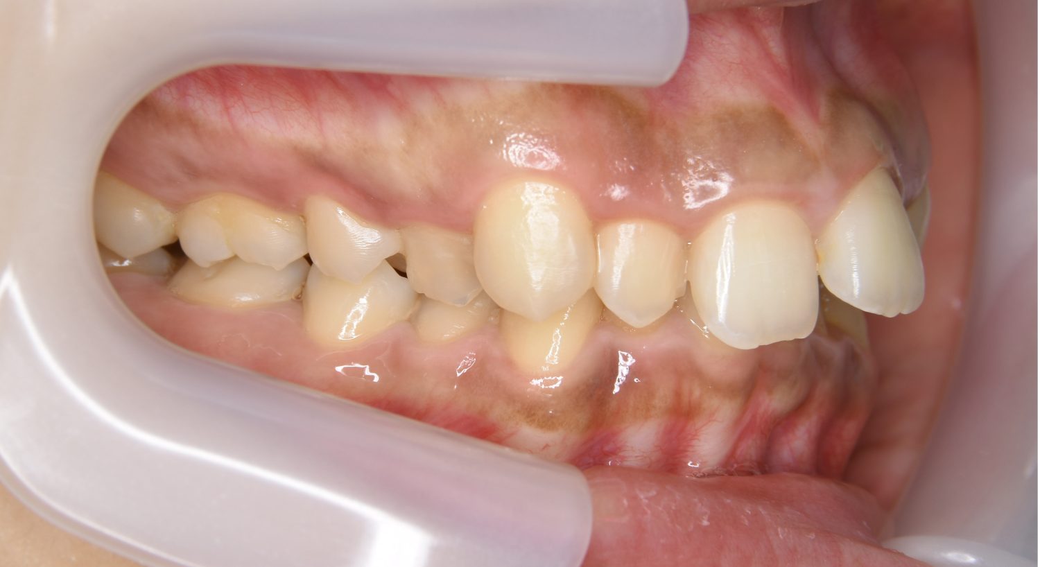 ピーススマイル矯正歯科 上顎前突② before 右側