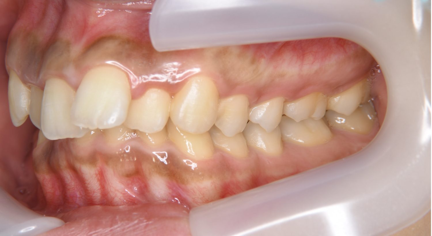 ピーススマイル矯正歯科 上顎前突② before 左側