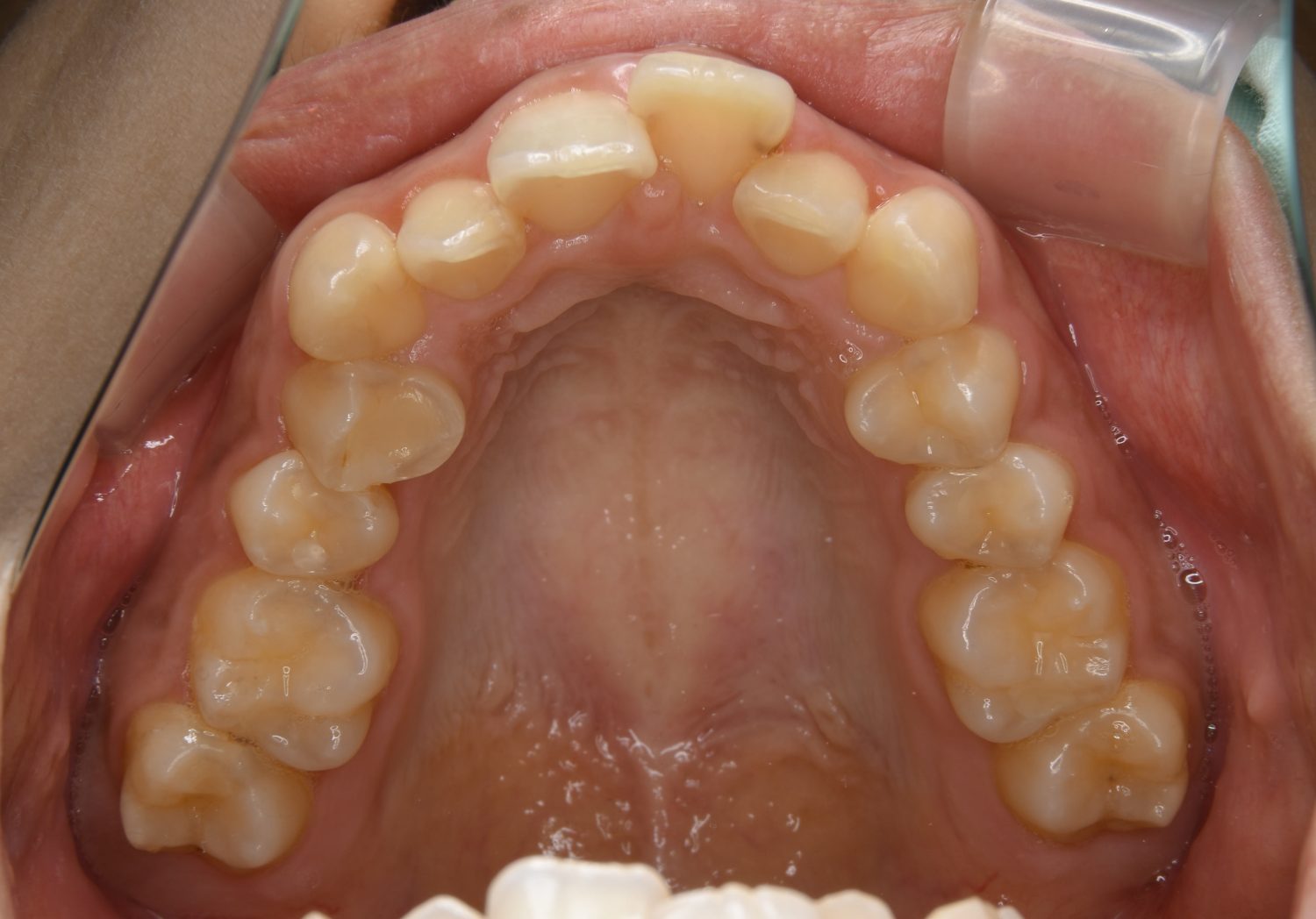 ピーススマイル矯正歯科 上顎前突② before 上側