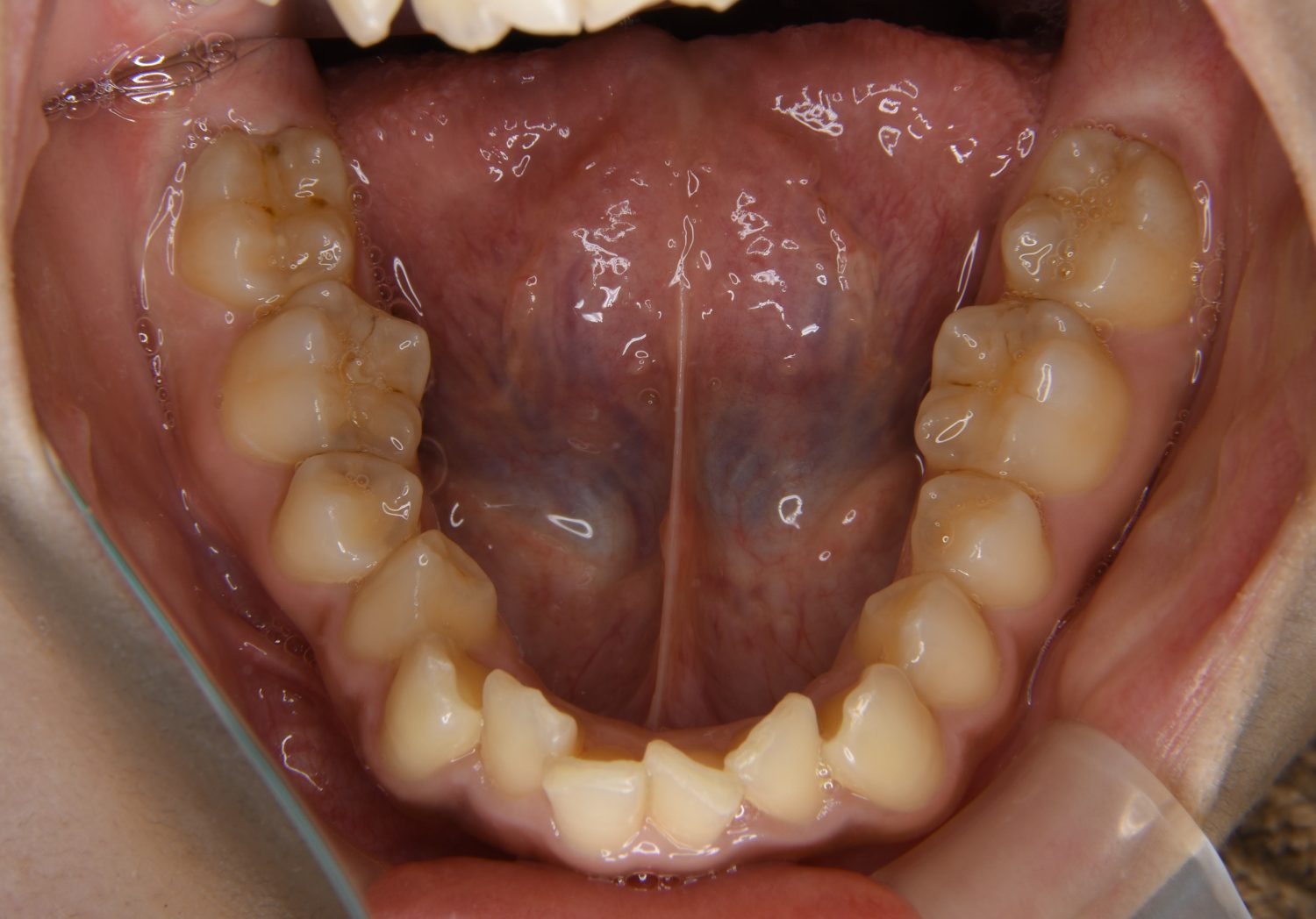 ピーススマイル矯正歯科 上顎前突② before 下側