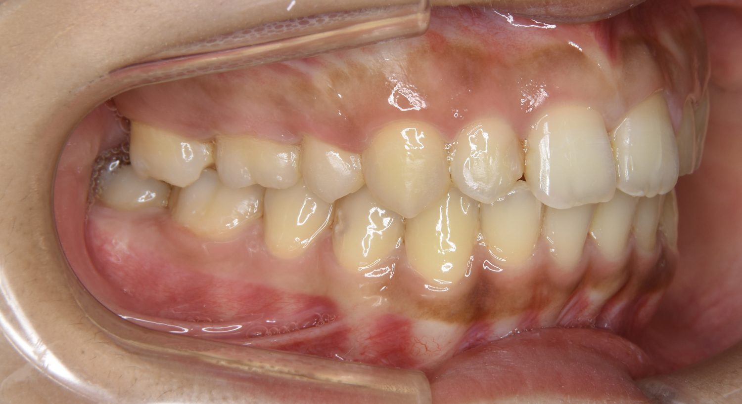 ピーススマイル矯正歯科 上顎前突② after 右側