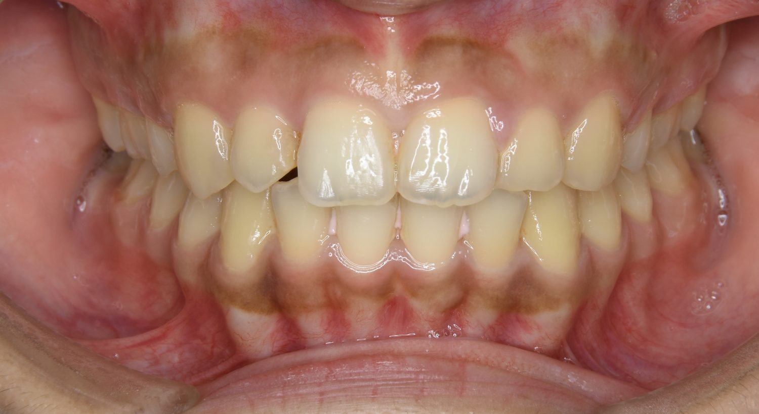 ピーススマイル矯正歯科 上顎前突② after 正面