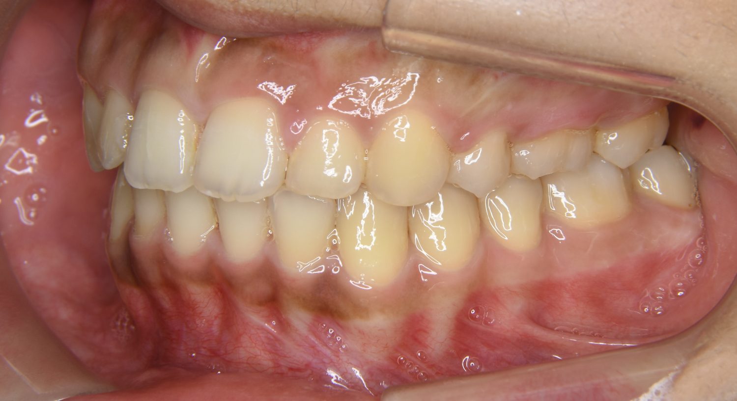 ピーススマイル矯正歯科 上顎前突② after 左側