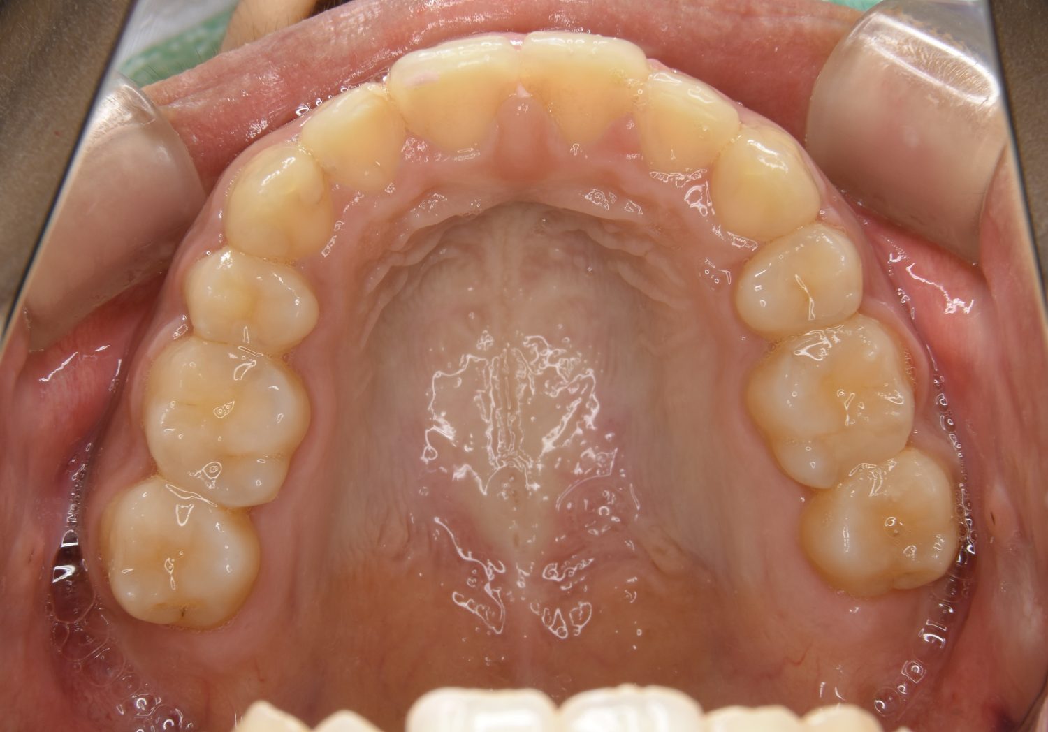 ピーススマイル矯正歯科 上顎前突② after 上側