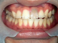 はりま歯科クリニック-ホワイトニング⑨-before-正面