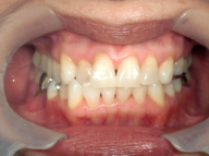 はりま歯科クリニック-ホワイトニング④-after-正面