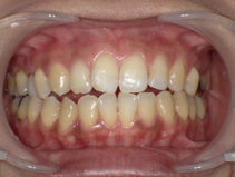 はりま歯科クリニック-ホワイトニング⑤-after-正面