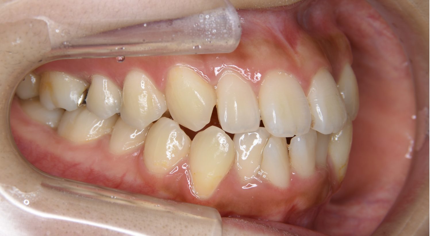 ピーススマイル矯正歯科 上下顎前突① before 右側