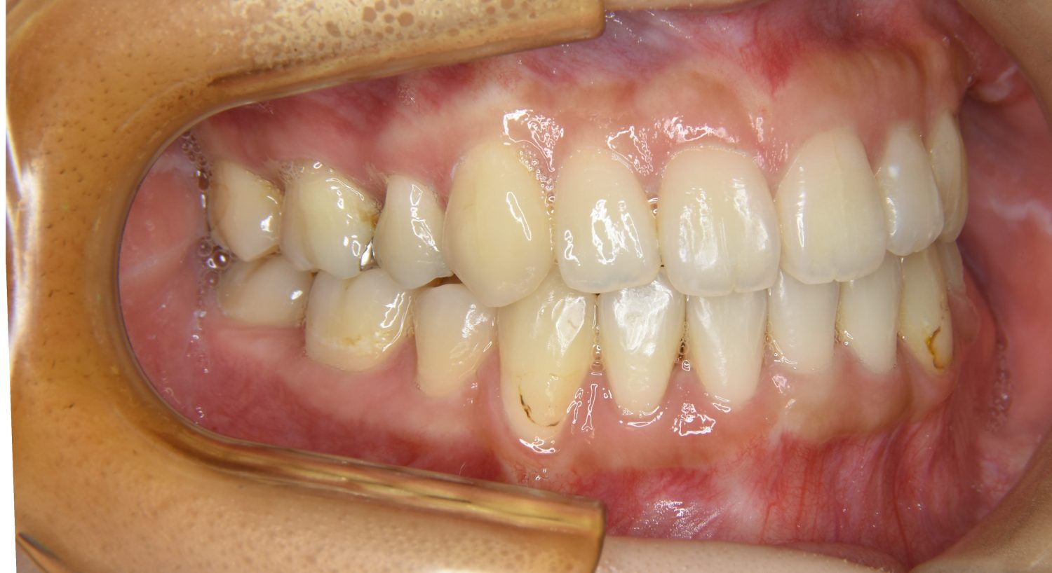 ピーススマイル矯正歯科 上下顎前突① after 右側