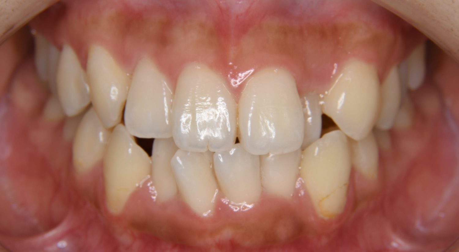 ピーススマイル矯正歯科 上下顎前突① before