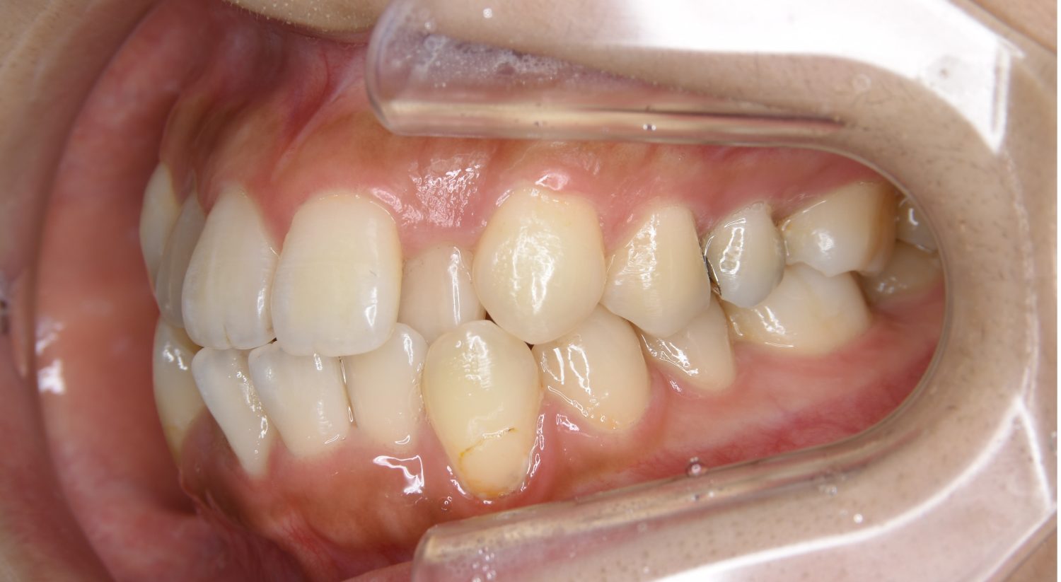 ピーススマイル矯正歯科 上下顎前突① before 左側