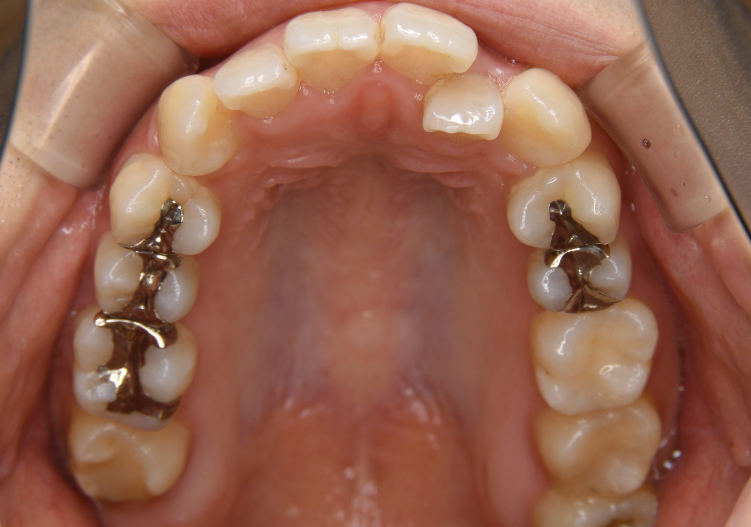 ピーススマイル矯正歯科 上下顎前突① before 上側