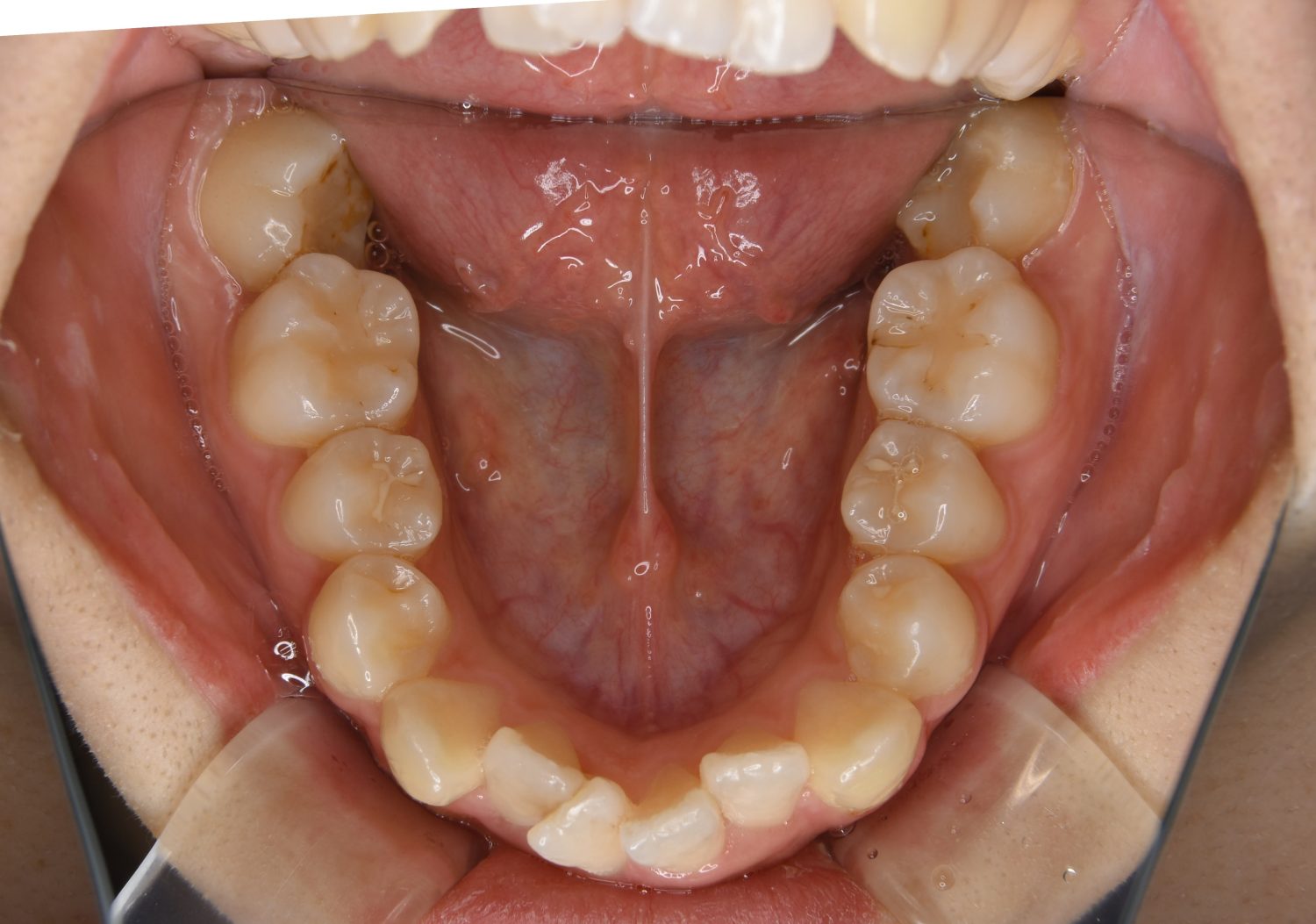 ピーススマイル矯正歯科 上下顎前突① before 下側