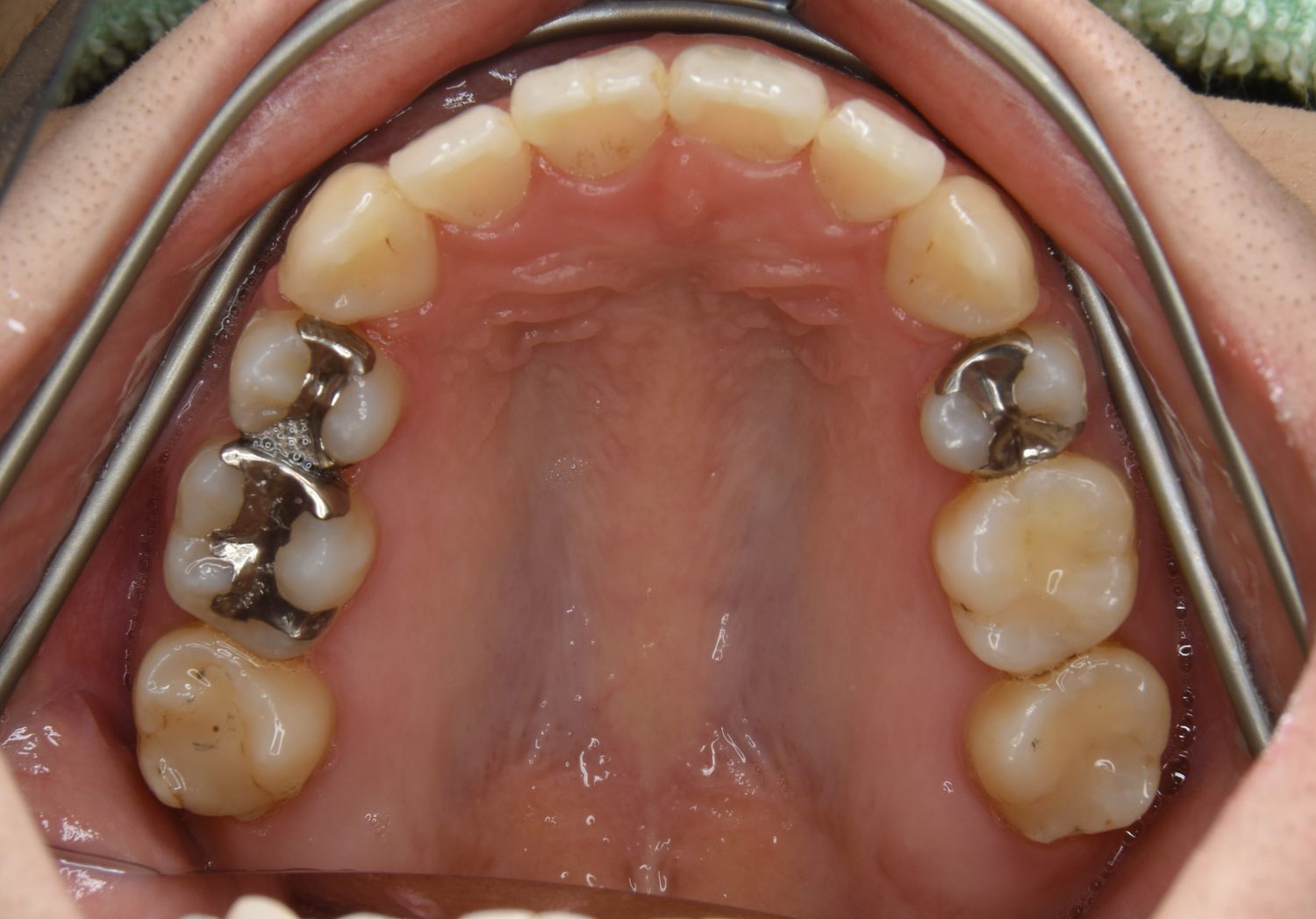 ピーススマイル矯正歯科 上下顎前突① after 上側