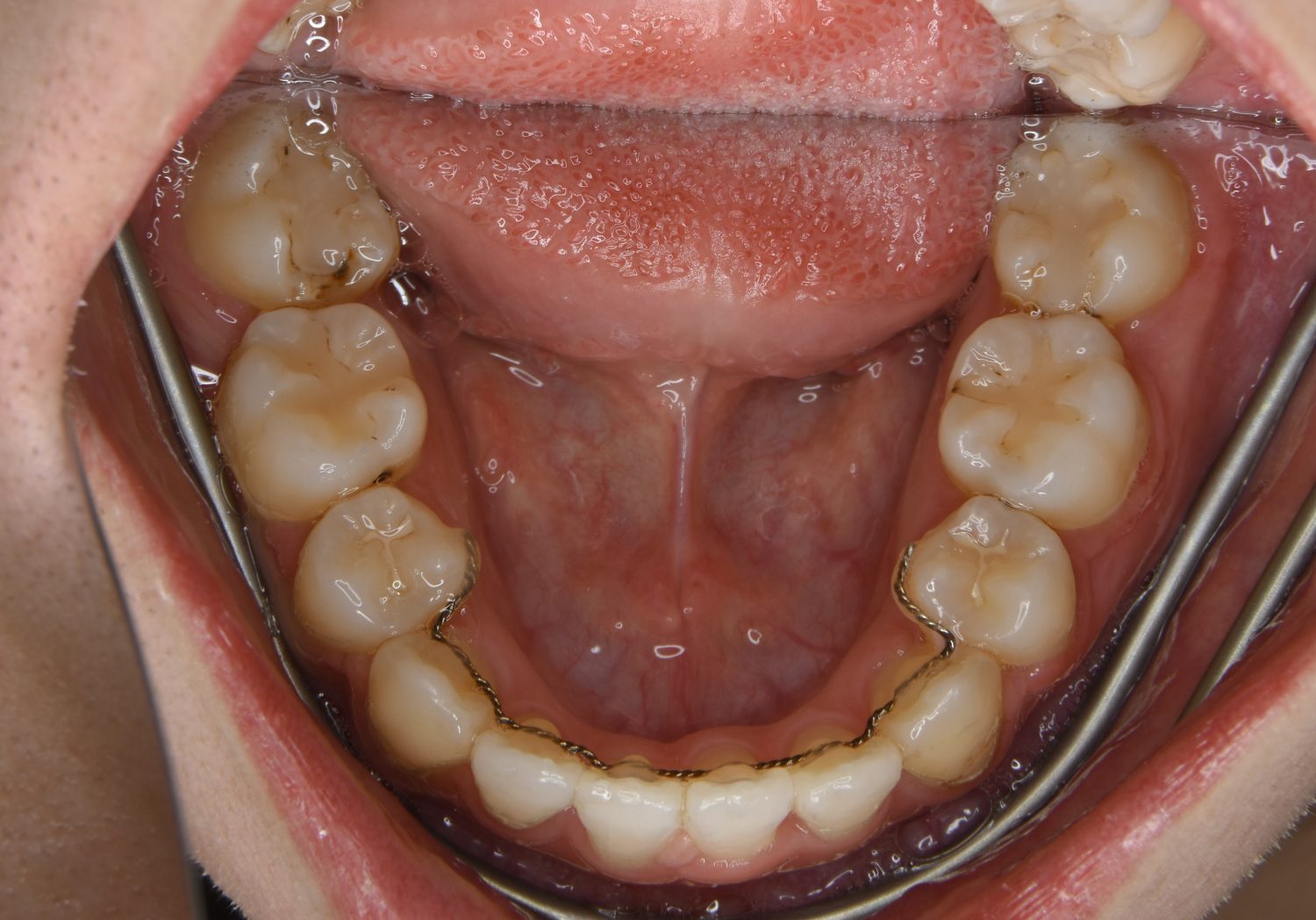 ピーススマイル矯正歯科 上下顎前突① after 下側