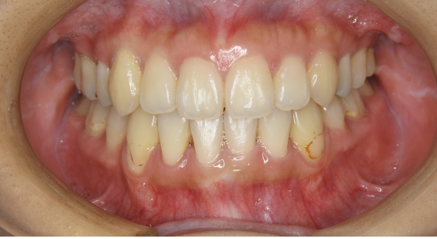 ピーススマイル矯正歯科 上下顎前突① after 正面