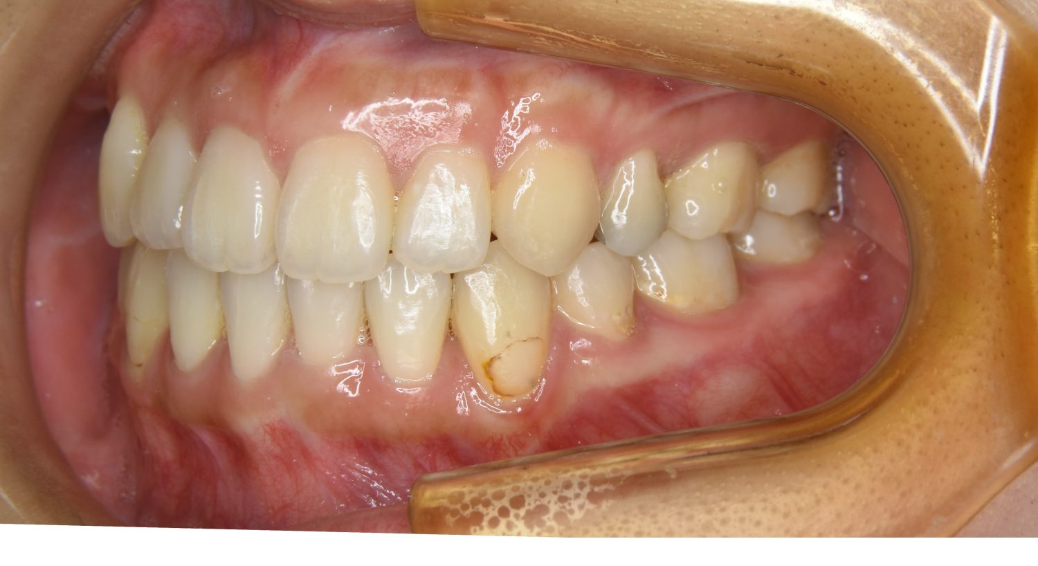 ピーススマイル矯正歯科 上下顎前突① after 左側