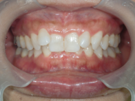 はりま歯科クリニック-ホワイトニング③-after-正面