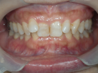 はりま歯科クリニック-ホワイトニング③-before-正面