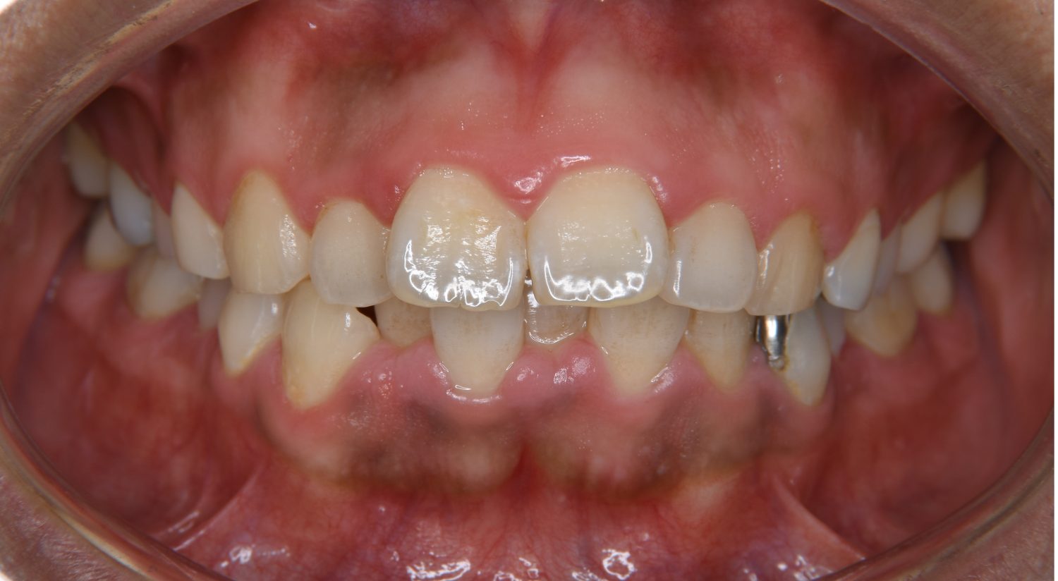 ピーススマイル矯正歯科 上下顎前突② before