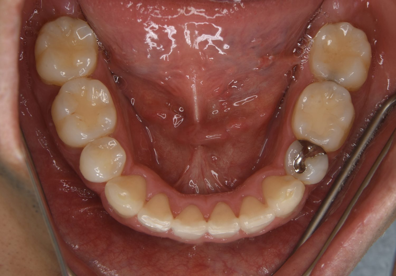 ピーススマイル矯正歯科 上下顎前突② after 下側