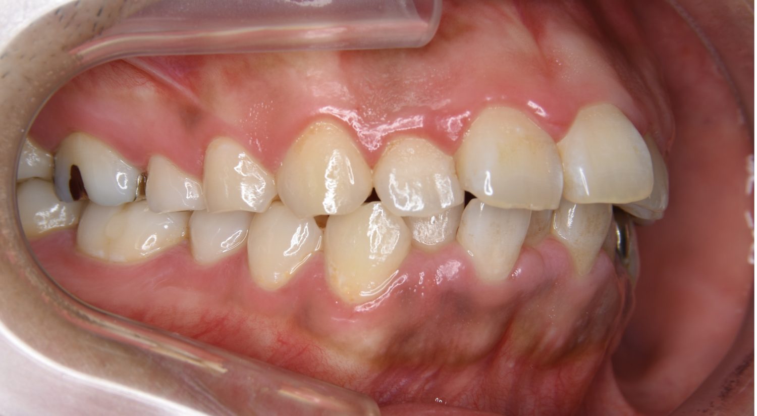 ピーススマイル矯正歯科 上下顎前突② before 右側