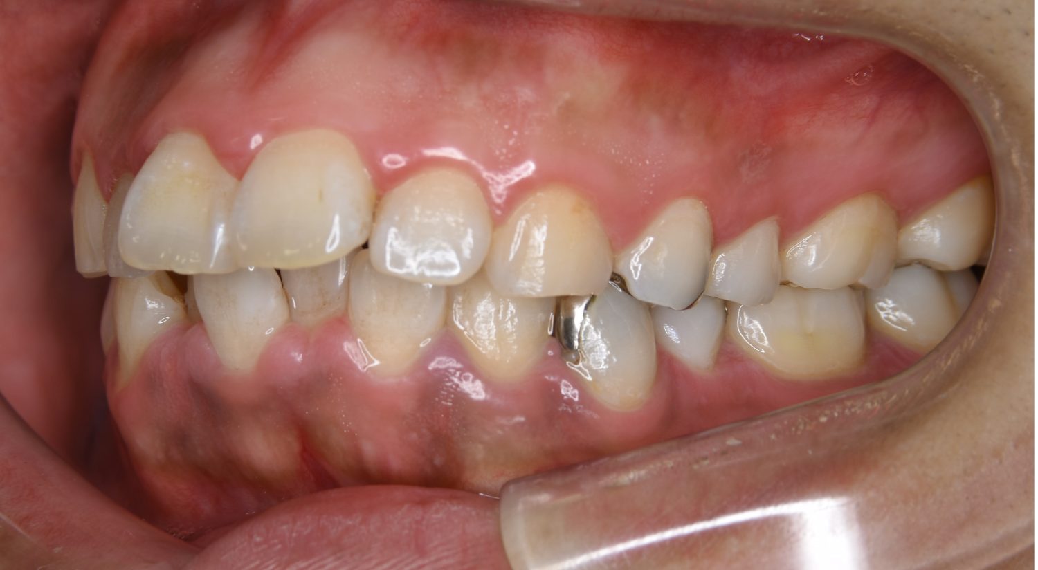 ピーススマイル矯正歯科 上下顎前突② before 左側