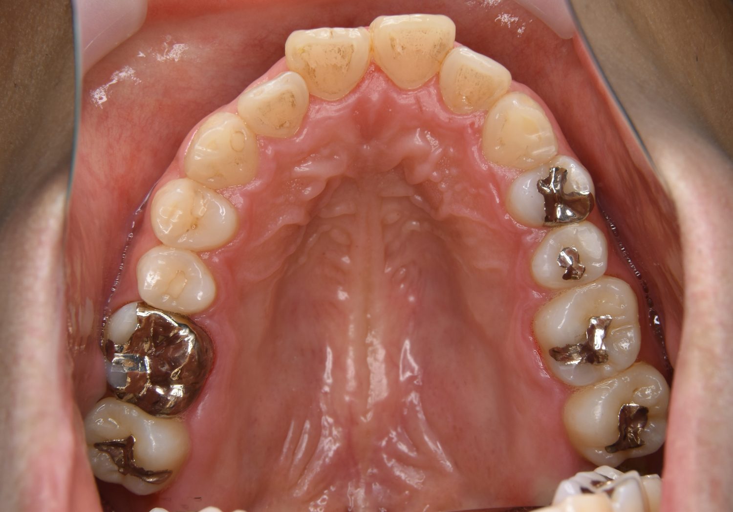 ピーススマイル矯正歯科 上下顎前突② before 上側