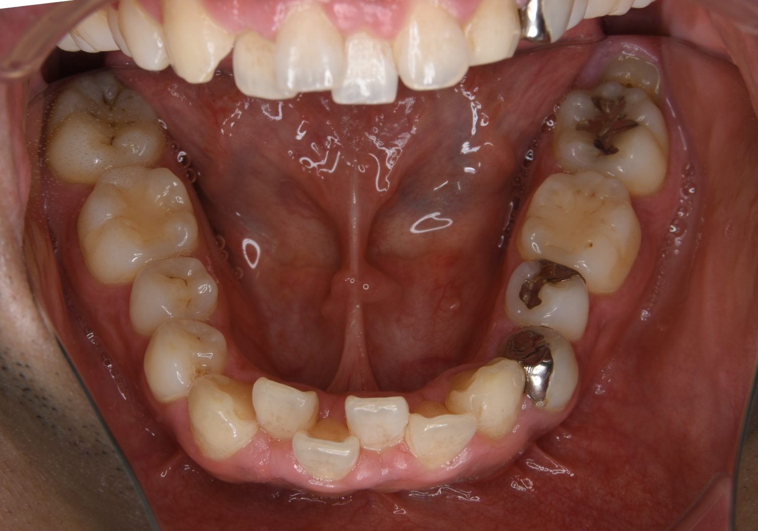 ピーススマイル矯正歯科 上下顎前突② before 下側