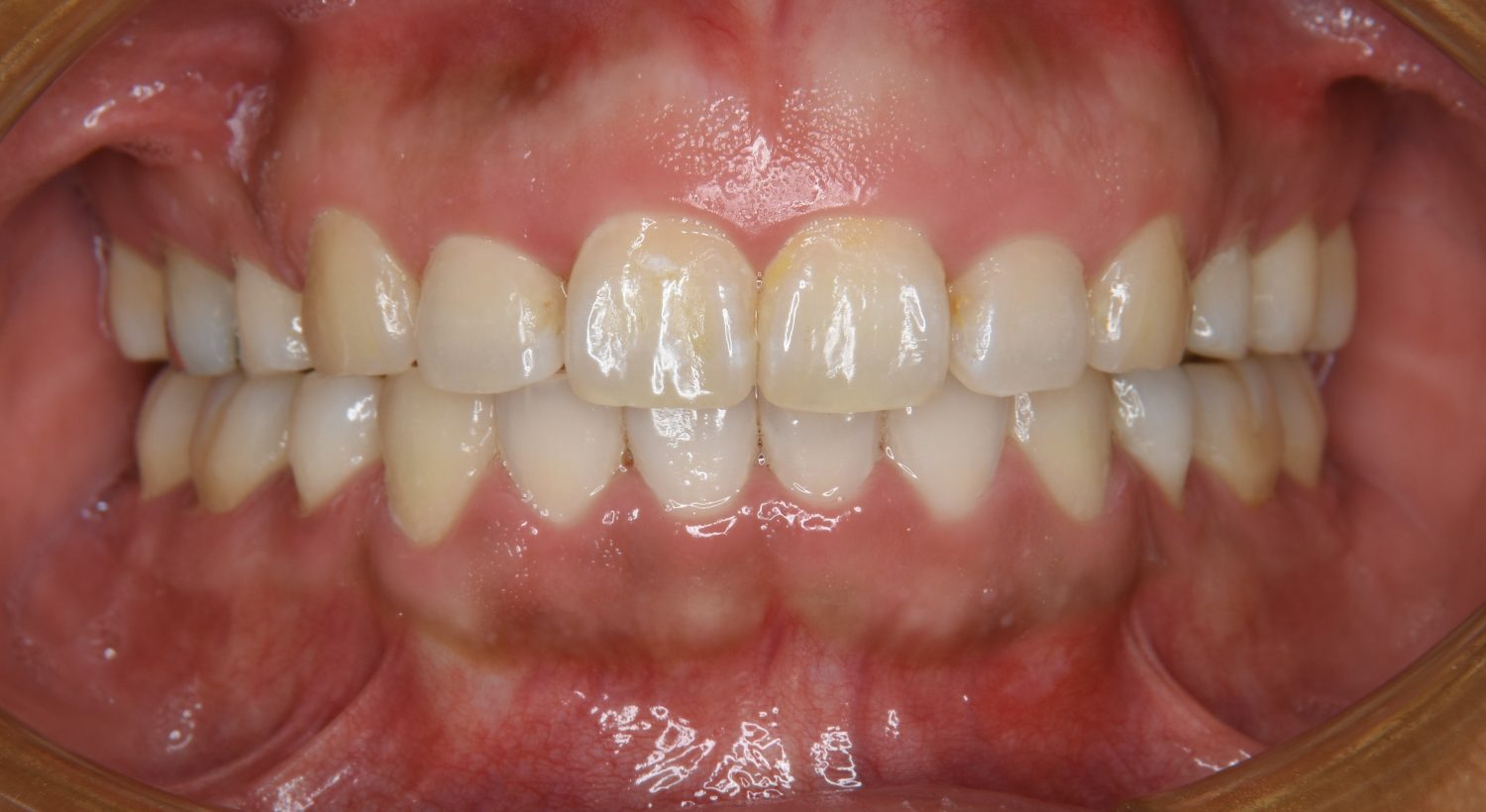 ピーススマイル矯正歯科 上下顎前突② after 正面