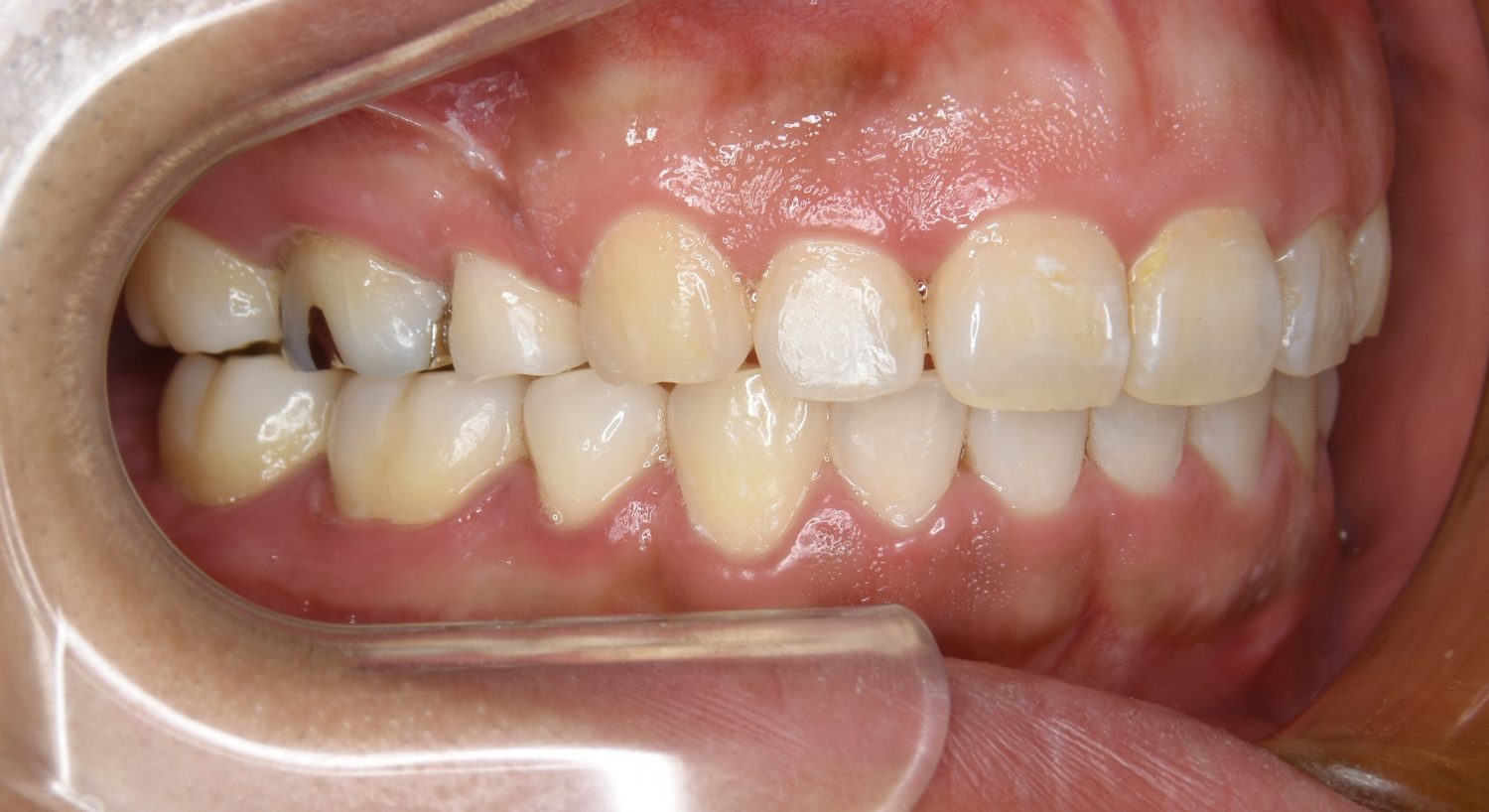 ピーススマイル矯正歯科 上下顎前突② after 右側