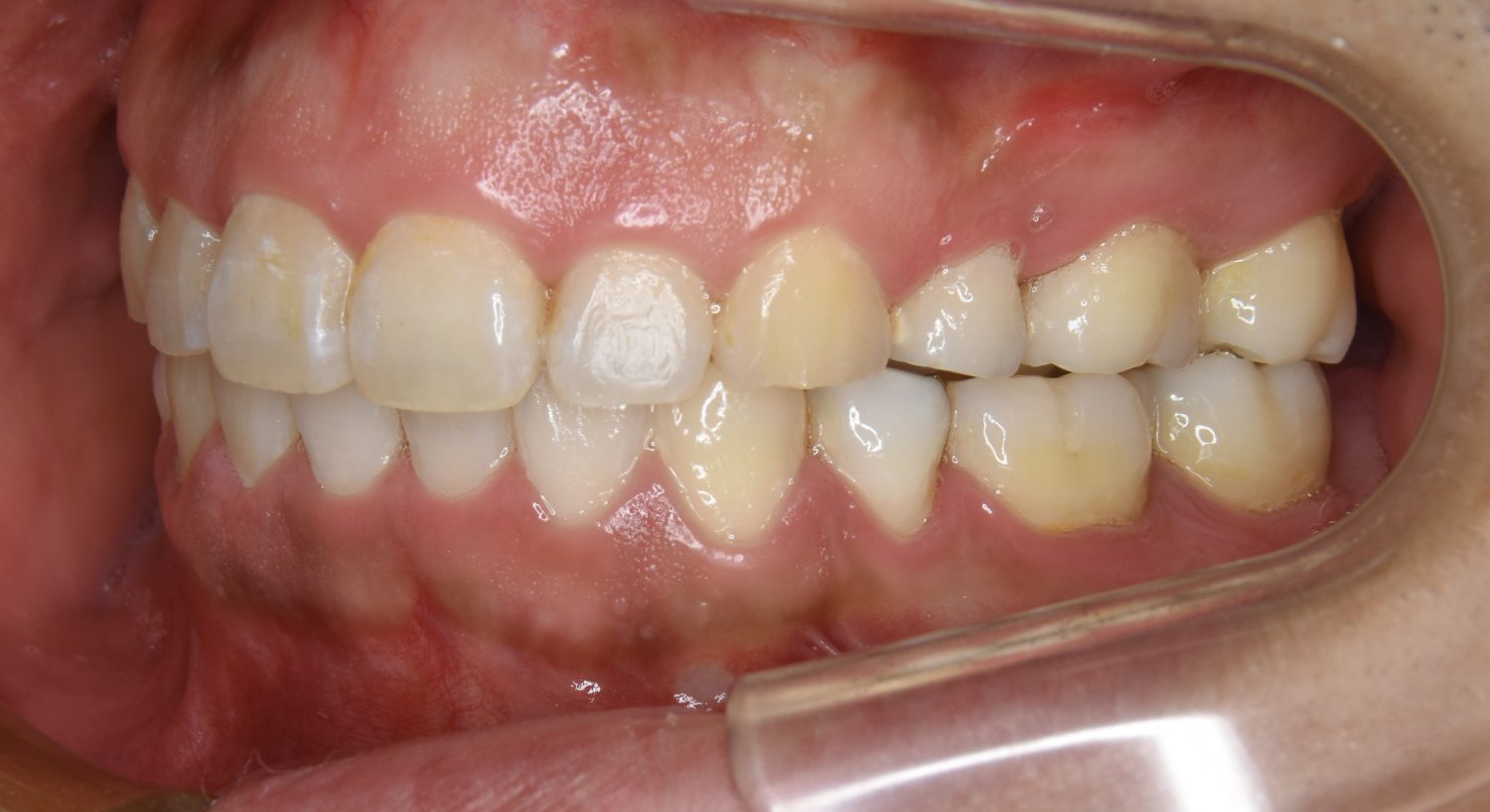 ピーススマイル矯正歯科 上下顎前突② after 左側